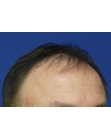 Before Hair Transplant&nbsp;Front